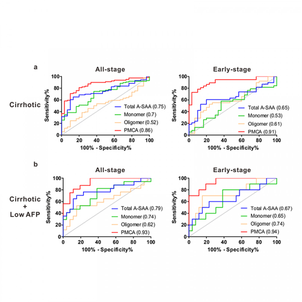 Acute-phase serum amyloid A for early detection of hepatocellular carcinoma in cirrhotic patients with low AFP level