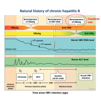 Serum soluble programmed cell death 1 levels predict spontaneous functional cure in inactive carriers with chronic hepatitis B