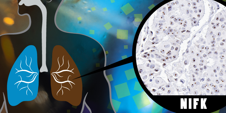 NIFK – What Causes Lung Cancer to Spread