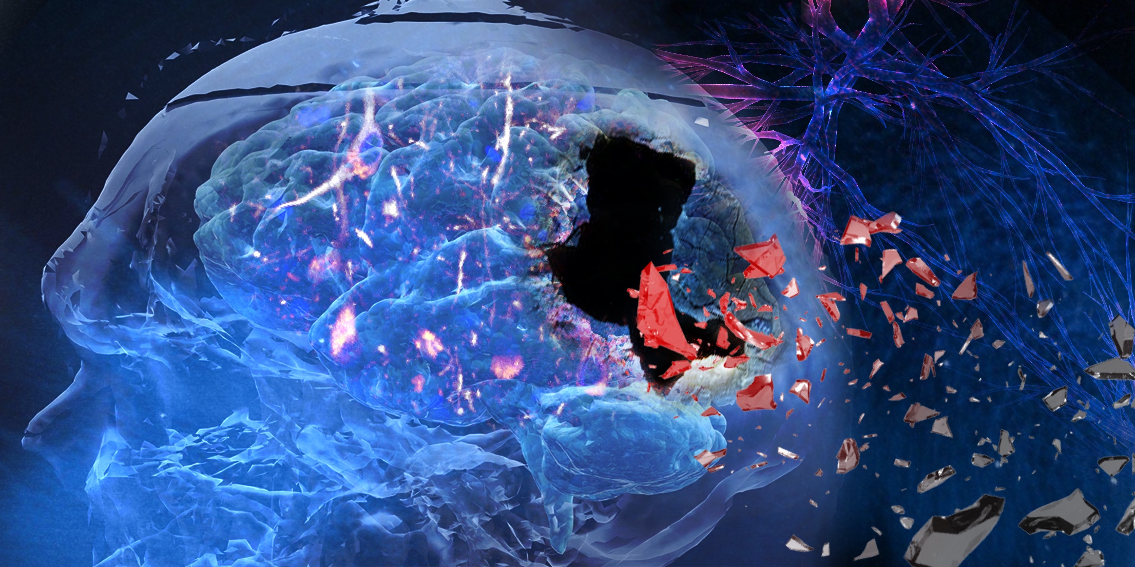 Curbing TDP-43 May Ease the Alzheimer’s Disease Progression