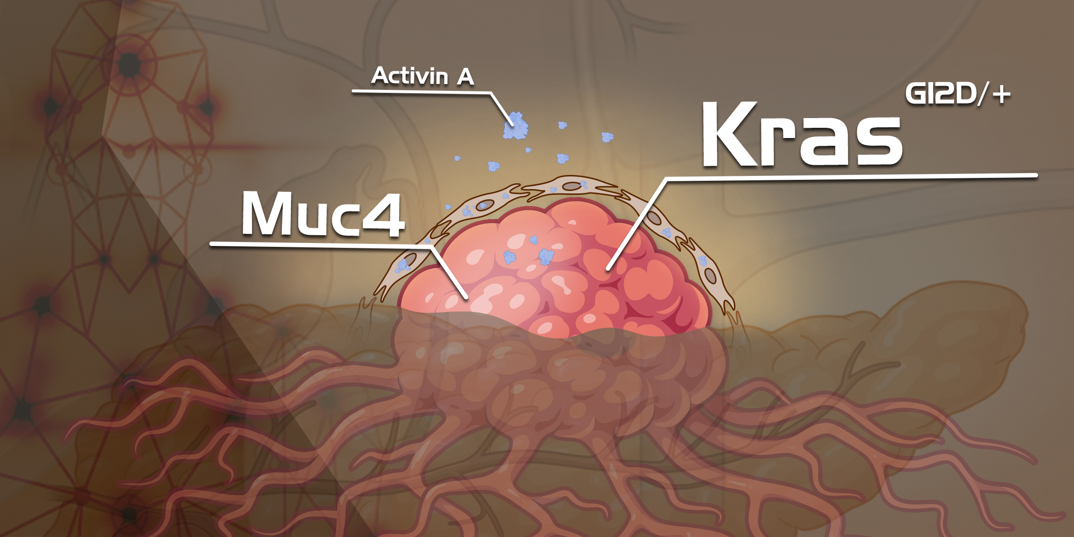 Unveiling the Mystery of Cancer-Causing KRAS Gene Driving Pancreatic Precancerous Lesions